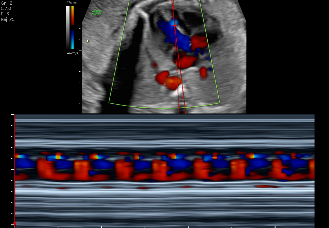 VSD de modo M anatómico en color