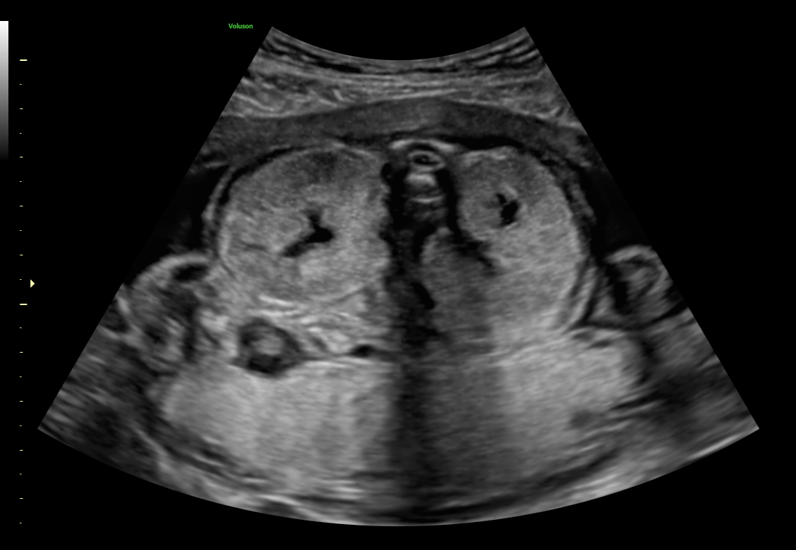 Riñones Poliquísticos