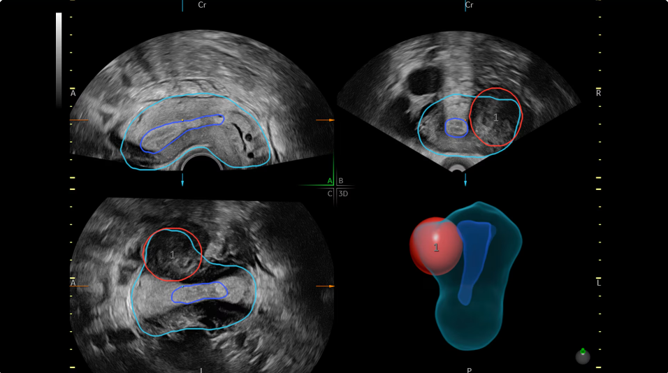 SonoGYN - Combina nuestra herramienta Uterine Trace y la función de mapeo de fibromas