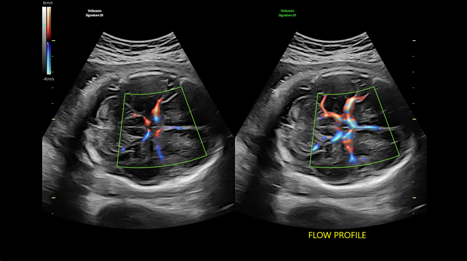 Optimización del Doppler de onda pulsada y color