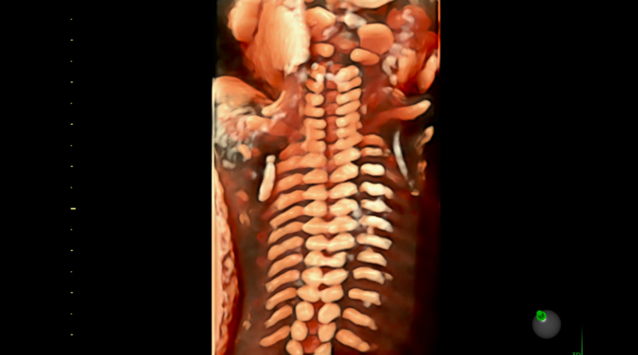 Columna vertebral fetal con HDlive™